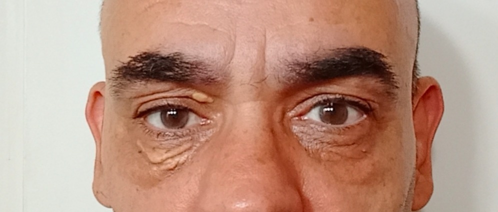 Spenden sammeln | Xanthelasma Entfernung und Tränensäcke Lifting | Spendenseite