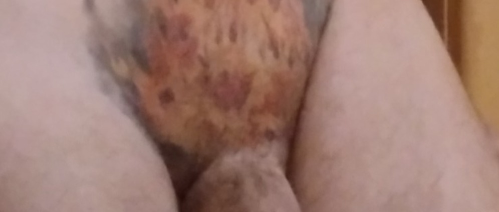 Spenden sammeln | Entfernung eines intim Tattoo | Spendenseite