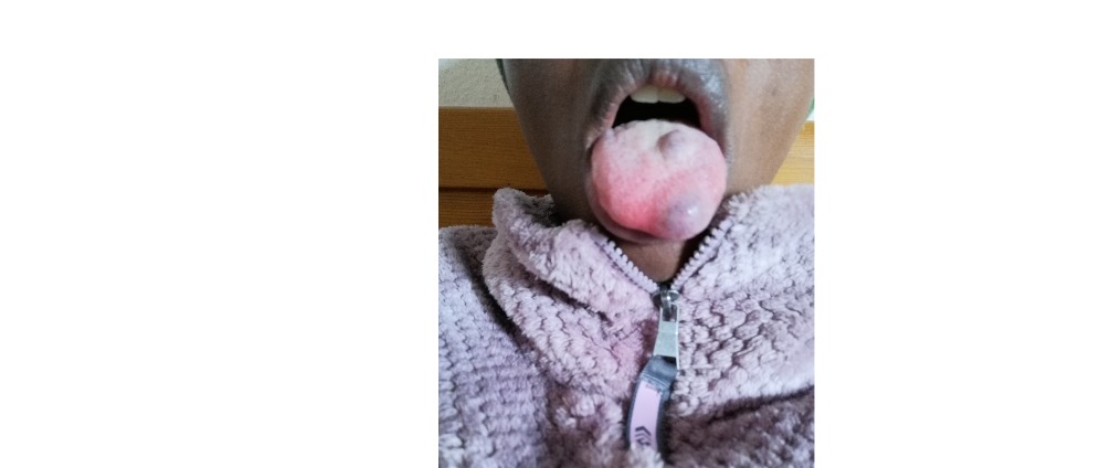 Spenden sammeln | GETTING A TONGUE SURGERY | Spendenseite