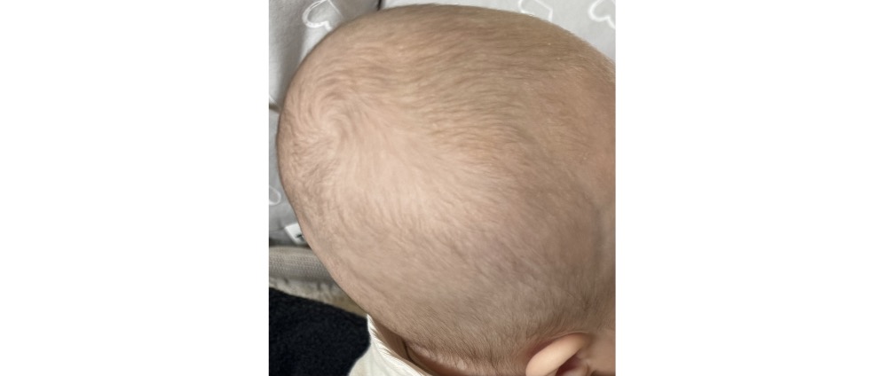 Spenden sammeln | Helmtherapie bei 4 Monate Baby | Spendenseite