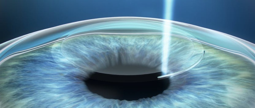 Spenden sammeln | Augen Lasern | Spendenseite
