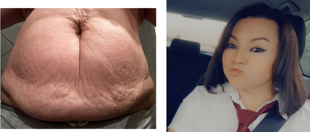 Spenden sammeln | Hilfe für eine bessere Psyche durch Bauch Brust Op | Spendenseite