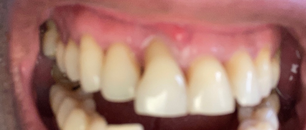 Spenden sammeln | Urgent teeth removal. Organs in risk | Spendenseite
