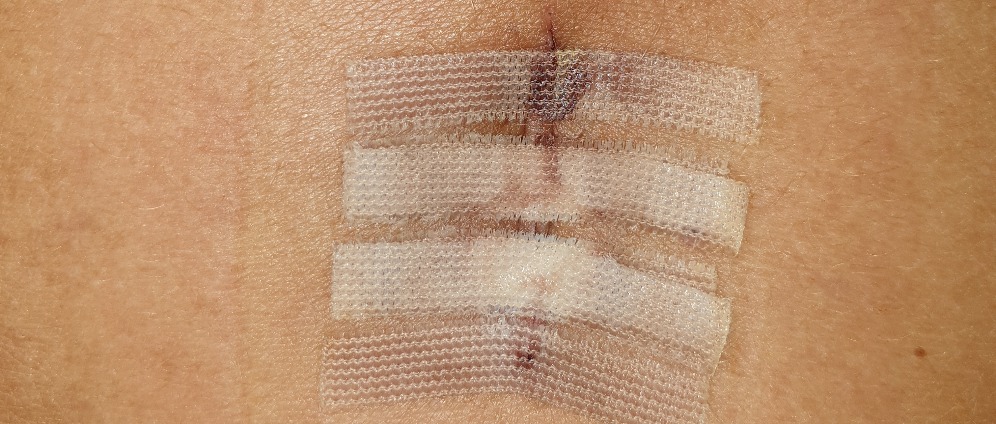 Spenden sammeln | 3 kaputte Bandscheiben, linkes Bein halb taub | Spendenseite