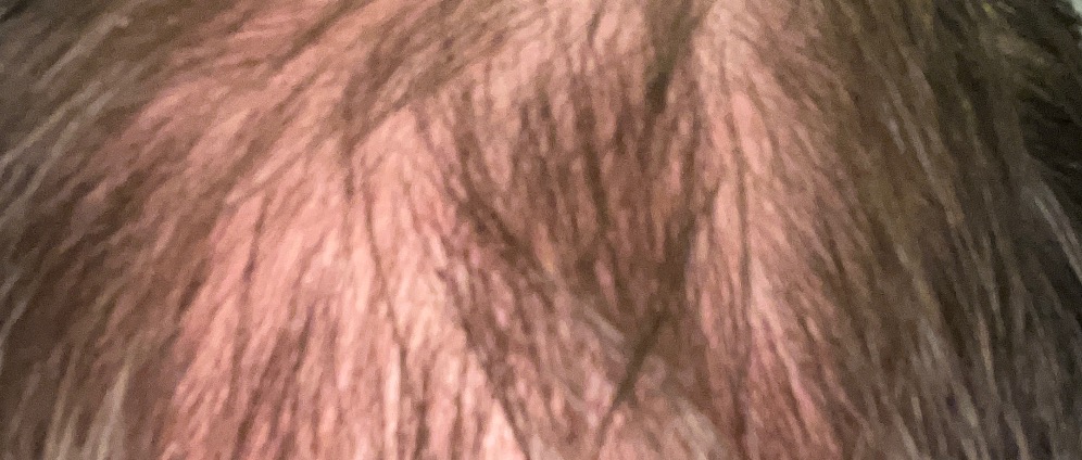 Spenden sammeln | Haartransplantation | Spendenseite
